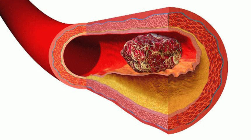 Тромб в сосудах симптомы и лечение
