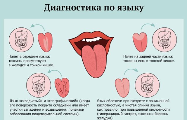 О каких болезнях расскажет ваш язык?